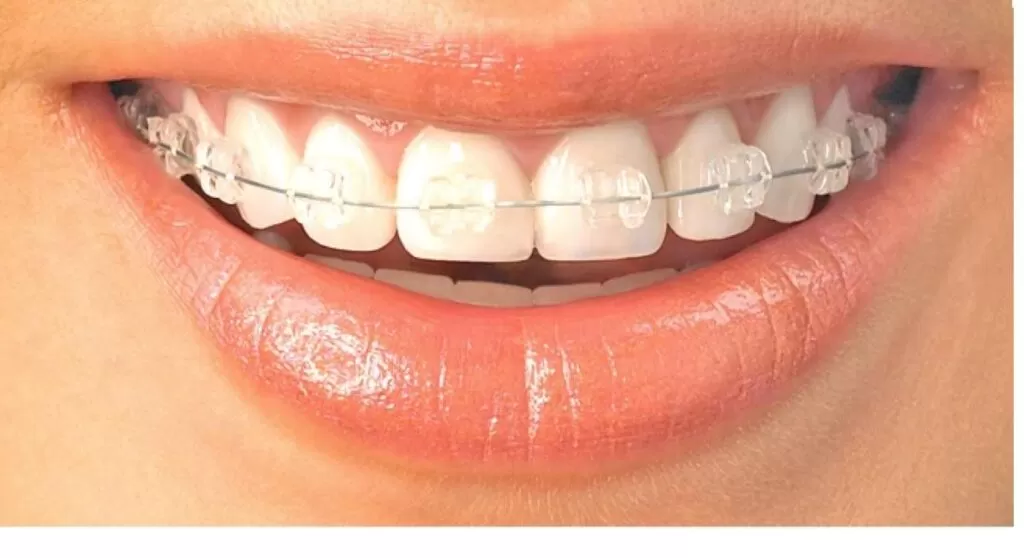 Caso de Sucesso - Aparelho Transparente